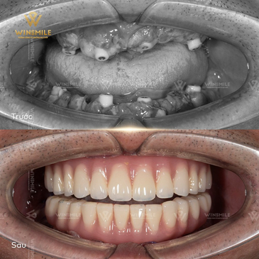 Slider image (6) WinSmile Dental Clinic Vietnam